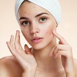 UMA MENINA QUE AINDA NÃO MENSTRUOU PODE USAR ANTICONCEPCIONAIS PARA DIMINUIR A ACNE?