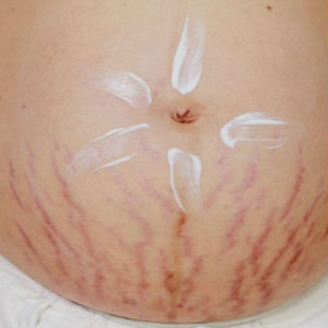 MÉDICA ENSINA PASSO A PASSO NADA DIFÍCIL PARA COMBATER ESTRIAS E ACNE NA GRAVIDEZ - Site Vix