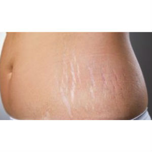 MÉDICA ENSINA PASSO A PASSO NADA DIFÍCIL PARA COMBATER ESTRIAS E ACNE NA GRAVIDEZ - Site Correio Feminino