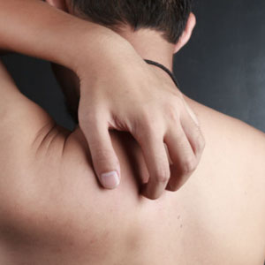 A DERMATITE NÃO TRATADA PODE SE ESPALHAR PELO CORPO? - Site Cuidados Pela Vida