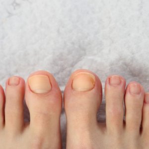 UNHAS DOS PÉS COM MICOSE?