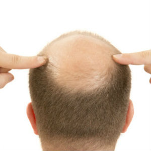 É POSSÍVEL DIMINUIR A QUEDA DE CABELO COM REMÉDIOS? - Site Cuidados pela Vida