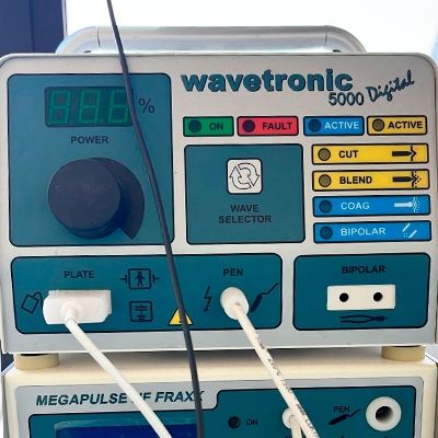 Cauterização com Wavetronic